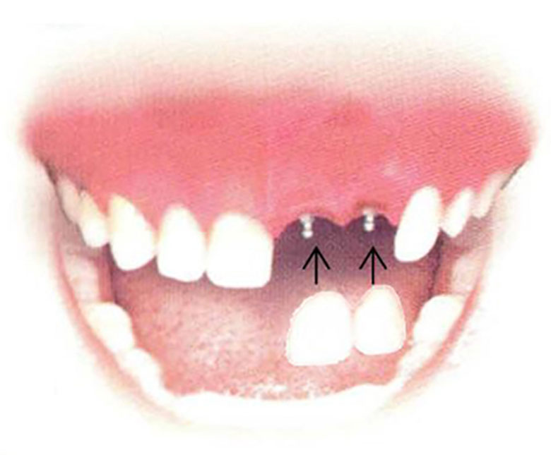 Dental Implant Solutions Buffalo, NY | 33 Melrose Rd suite 1, Buffalo, NY 14221, USA | Phone: (716) 791-9957