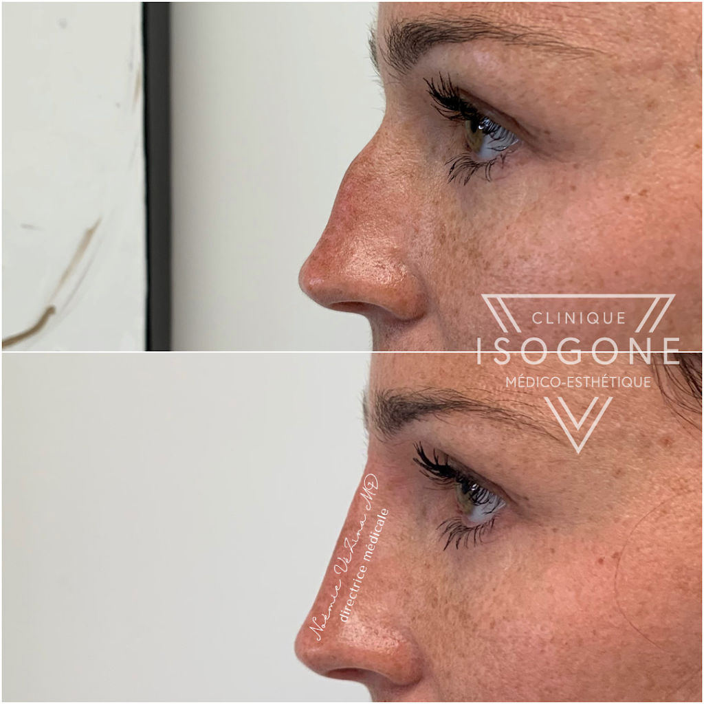 Clinique Isogone Médico-Esthétique | 1435 Boulevard Saint-Martin O Suite 502, Laval, QC H7S 2C6, Canada | Phone: (450) 667-6676