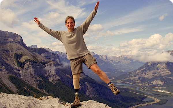 Cascade Prosthetic Services | 2636 Parkdale Blvd NW E, Calgary, AB T2N 3S6, Canada | Phone: (403) 283-7872