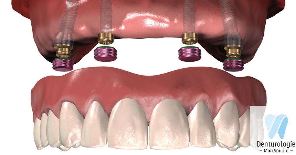 Denturologie Mon Sourire I Denturologiste Saint Laurent | 2505 Rue des Nations, Saint-Laurent, QC H4R 3C8, Canada | Phone: (514) 506-4983