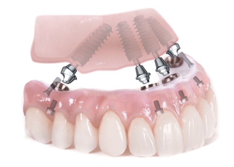 The Tooth Shoppe Denture Clinic | 5990 16th Ave #212, Markham, ON L3P 7R2, Canada | Phone: (905) 471-3381