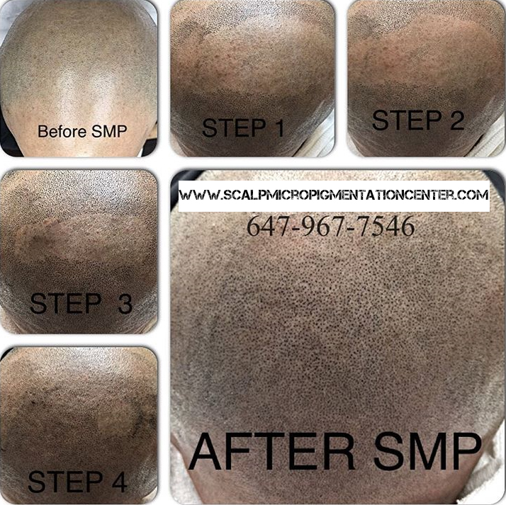 Scalp Micropigmentation Training Center Head Office | 19 Aerodrome Crescent #301, East York, ON M4G 4J3, Canada | Phone: (844) 877-2257