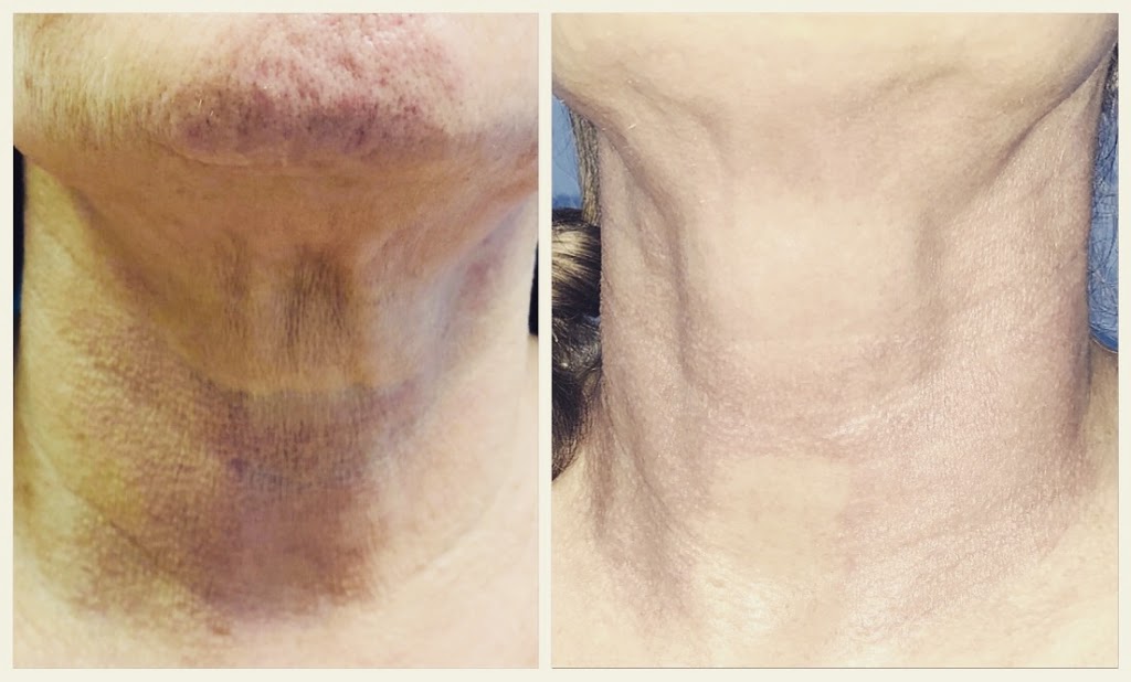 iBrow & Laser Clinic | 1595 Bedford Highway Suite 228, Sunnyside Mall, Bedford, NS B4A 3Y4, Canada | Phone: (902) 406-9526