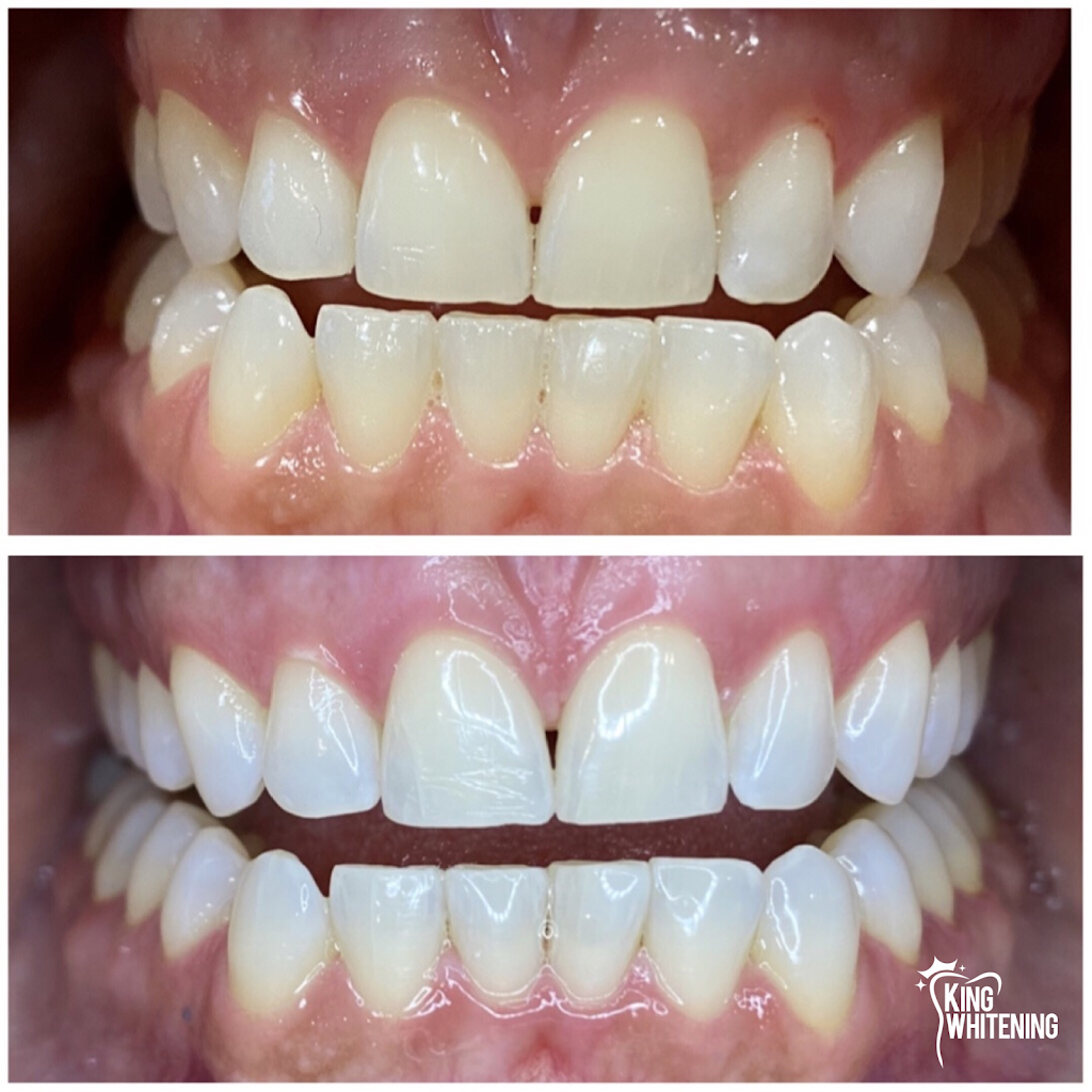 King Whitening | 12 Kingsland Ave, Mulmur, ON L9V 3H1, Canada | Phone: (416) 888-5546