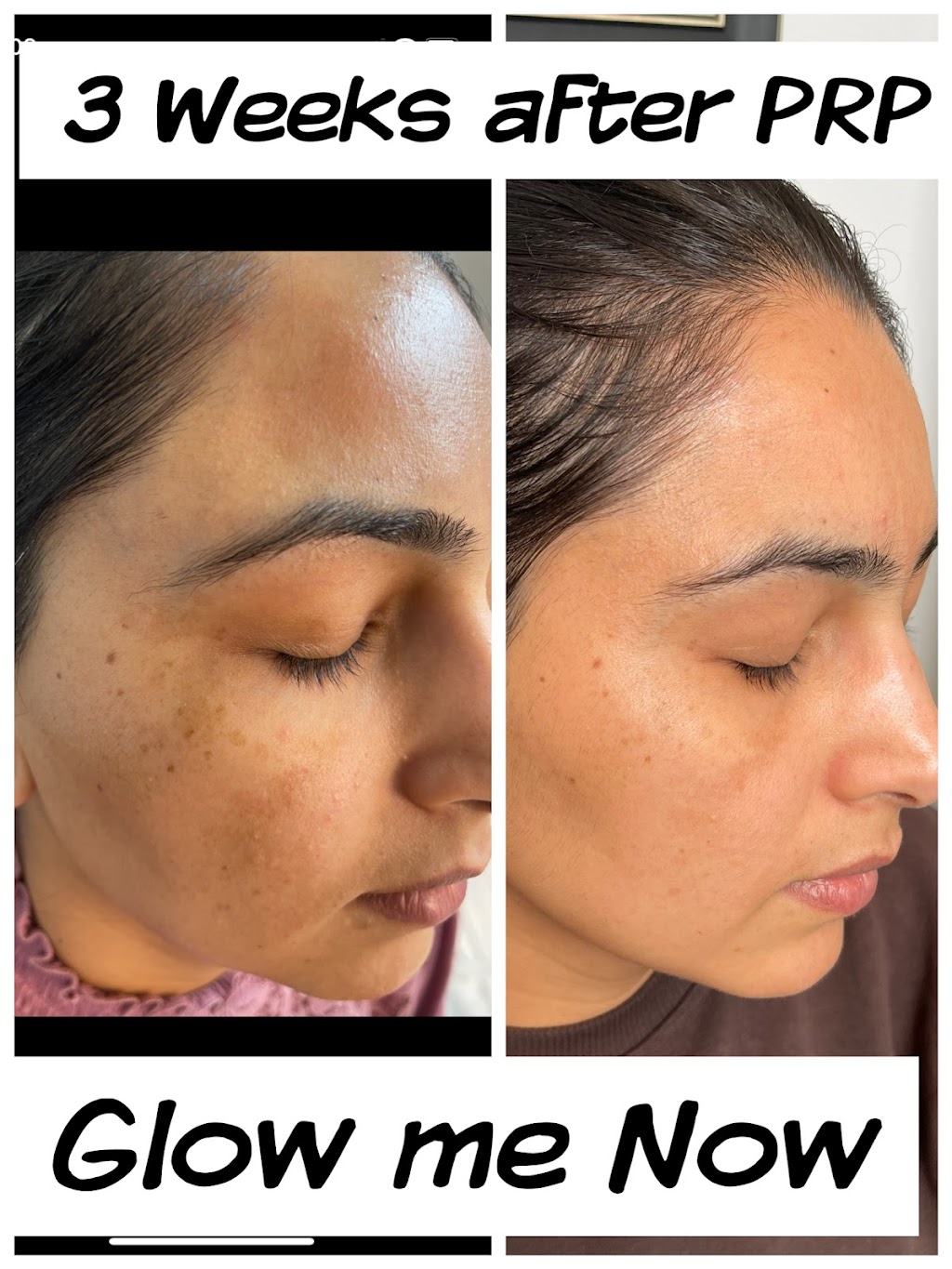 Glow Me Now Aesthetic Lounge & Medi Spa | 1199 Alberni Rd, Woodstock, ON N4T 0H9, Canada | Phone: (647) 767-3349
