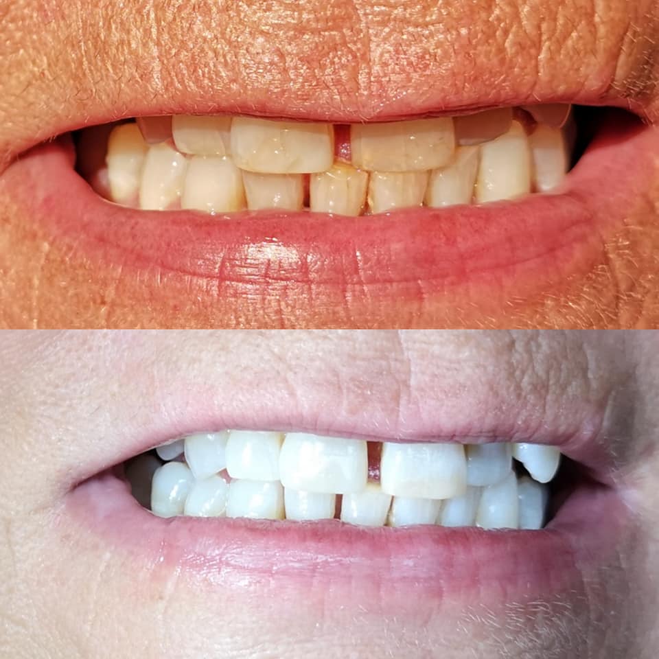 Brighter Smiles by Jax | 82 Rice Ave, Hamilton, ON L9C 5V9, Canada | Phone: (905) 512-3707