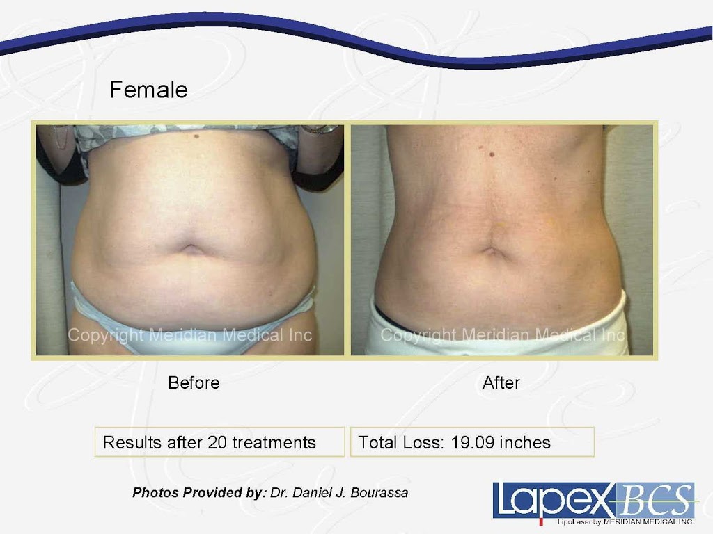North of Naked Lipolaser Boutique | 2107 W 16th Ave, Vancouver, BC V6K 3B1, Canada | Phone: (604) 563-5032