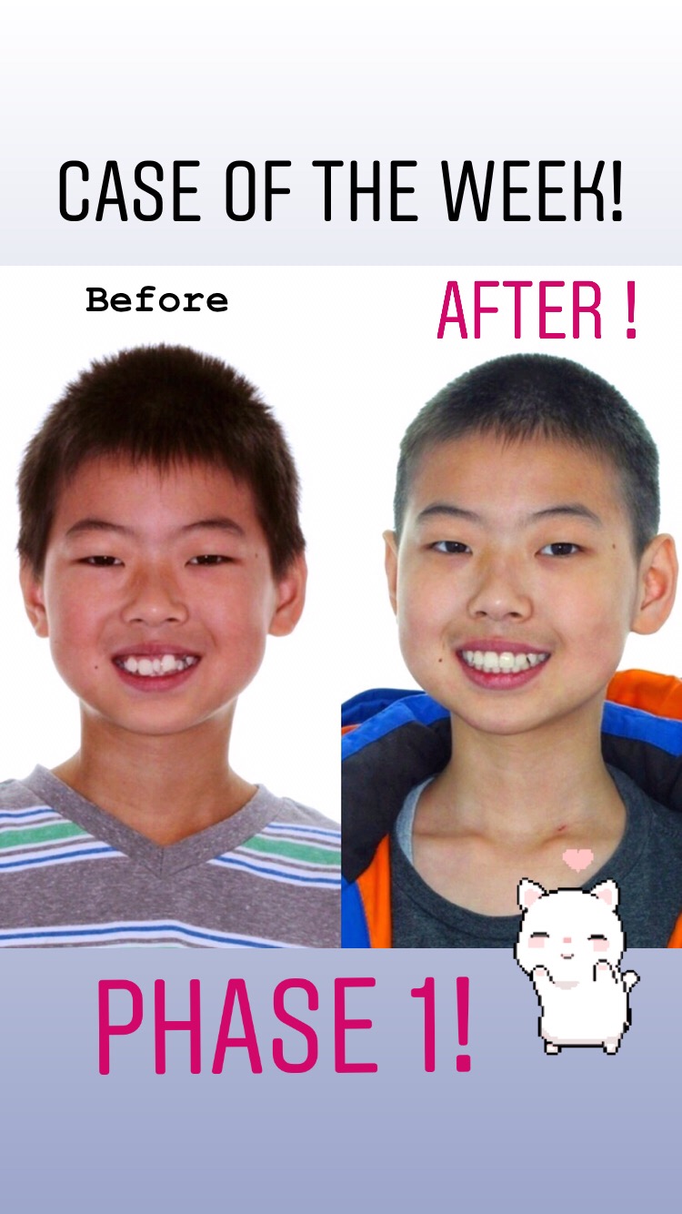 SmileZone Orthodontics | 31 Southridge Dr #151, Okotoks, AB T1S 1V3, Canada | Phone: (587) 757-9440