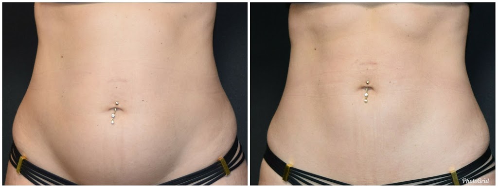 (Hygieia Medical Clinic) Discover Coolsculpting @Merle Norman | 5629 Signal Hill Centre SW, Calgary, AB T3H 3P8, Canada | Phone: (403) 249-1979
