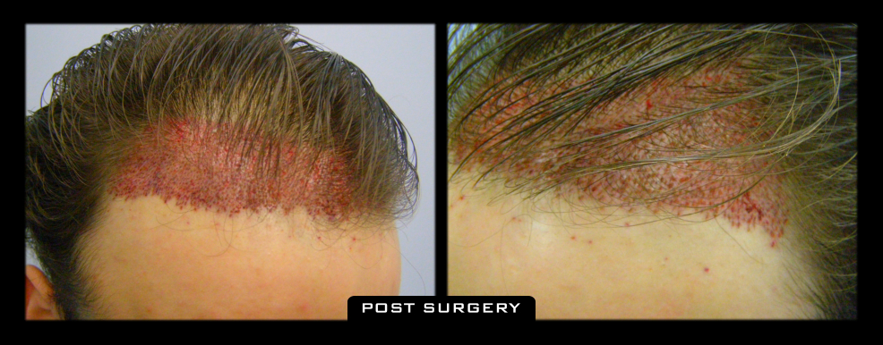 NuHair Medical Hair Transplant Centre | 4040 Veterans Pl NW Unit 200, Calgary, AB T3B 3R7, Canada | Phone: (403) 923-5954