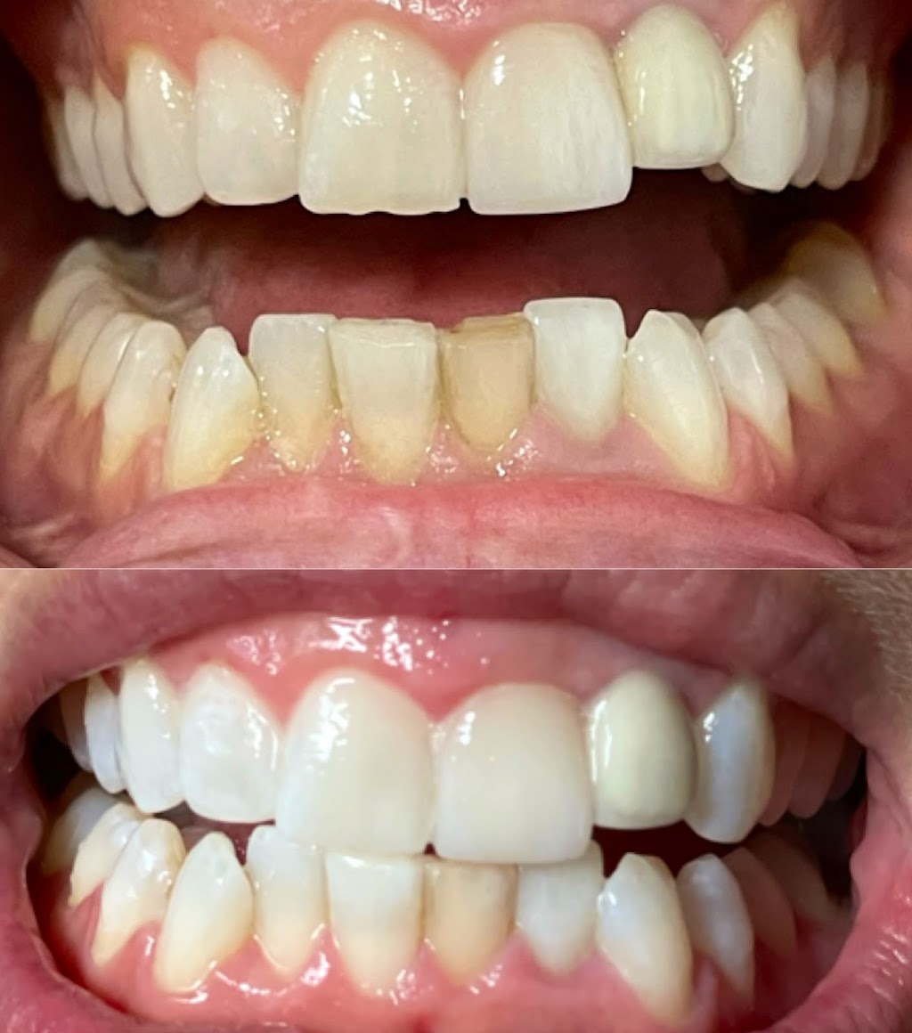 Smirk to Smile Teeth Whitening | 10 Jensen Crescent NE, Airdrie, AB T4B 1P4, Canada | Phone: (403) 404-1421