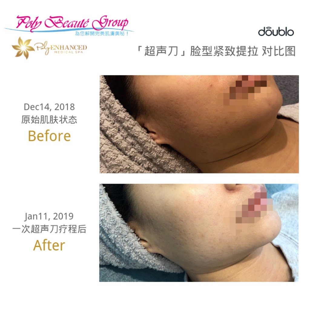 Poly Enhanced Medical Spa | 7335 Yonge St, Thornhill, ON L3T 1P9, Canada | Phone: (416) 855-3138