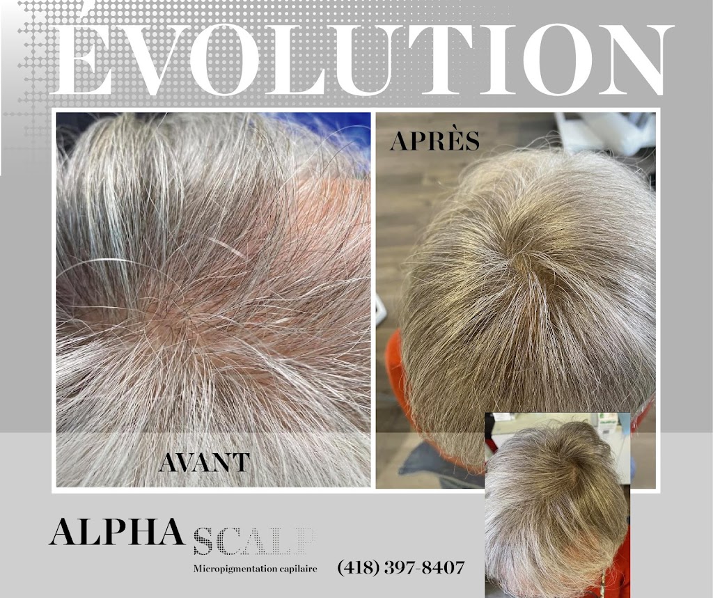 Alpha Scalp | 220 Rue Marius Barbeau, Saint-Joseph-de-Beauce, QC G0S 2V0, Canada | Phone: (418) 397-8407