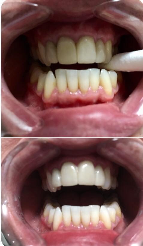 Sensational Smile Whitening | 16748 61 St NW, Edmonton, AB T5Y 0W7, Canada | Phone: (780) 221-6240