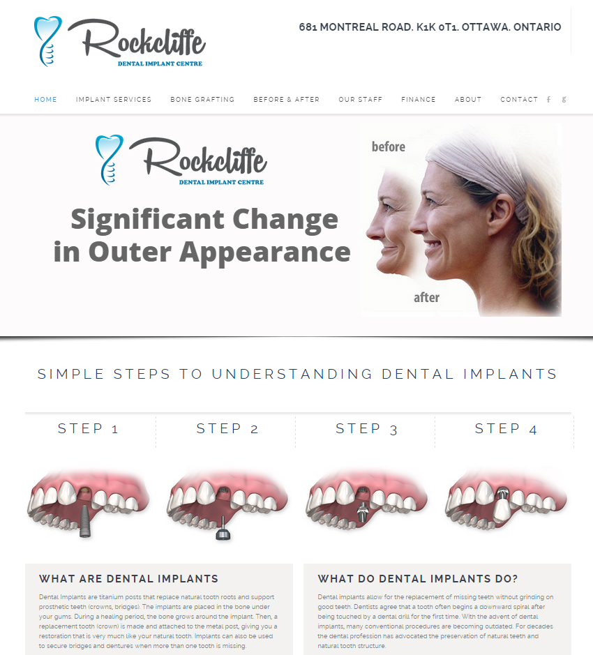 DENTAL IMPLANTS OTTAWA - DR. KONIOUCHINE | 681 Montréal Rd, Ottawa, ON K1K 0T1, Canada | Phone: (613) 746-5050
