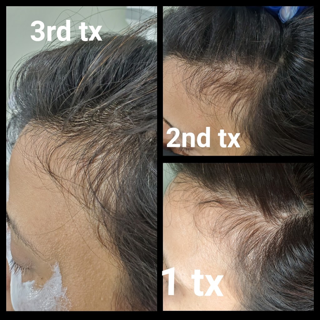 Rejuven Med Spa | 310 Chancellor Dr, Woodbridge, ON L4L 7M1, Canada | Phone: (647) 281-9951