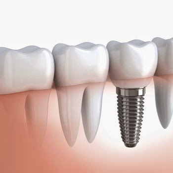 Francois Jean Denturologiste | 248 Boulevard Saint-Luc, Saint-Jean-sur-Richelieu, QC J2W 1C3, Canada | Phone: (450) 349-2425