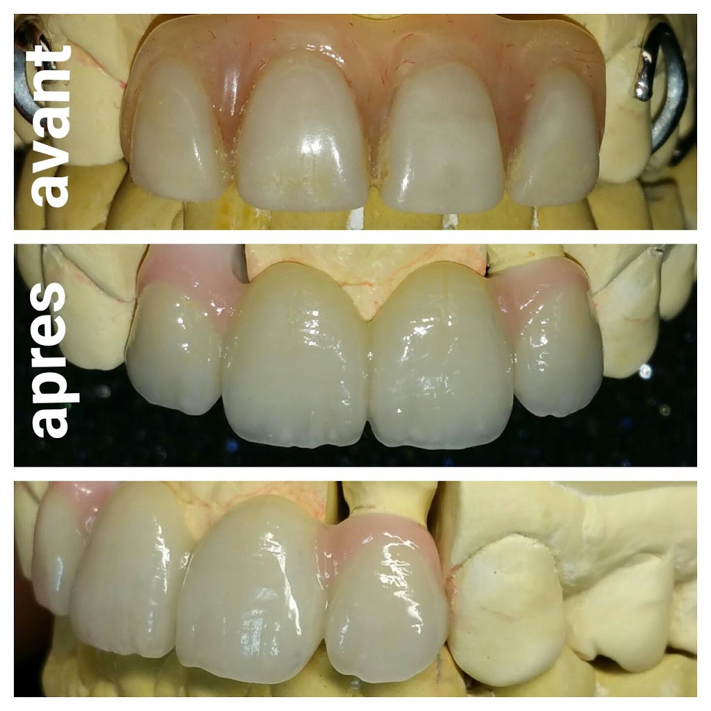 Laboratoire Dentaire T&T inc. | 3960 Rue Forester, Saint-Hubert, QC J3Y 1W2, Canada | Phone: (514) 812-5949