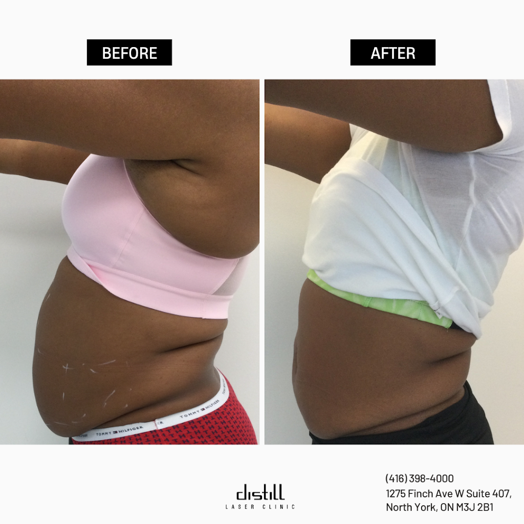 Distill Laser Clinic Oakville | 3075 Hospital Gate Suite 422, Oakville, ON L6M 1M1, Canada | Phone: (905) 827-8445