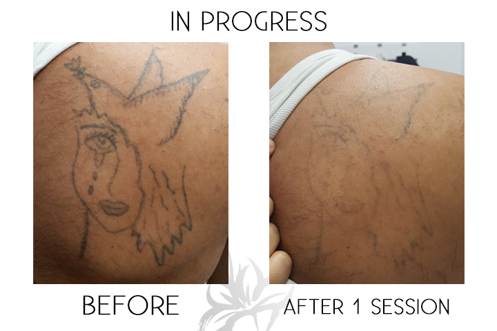 Azalea Laser Clinic | 7567 Blvd. Newman, LaSalle, QC H8N 1X3, Canada | Phone: (844) 429-2532