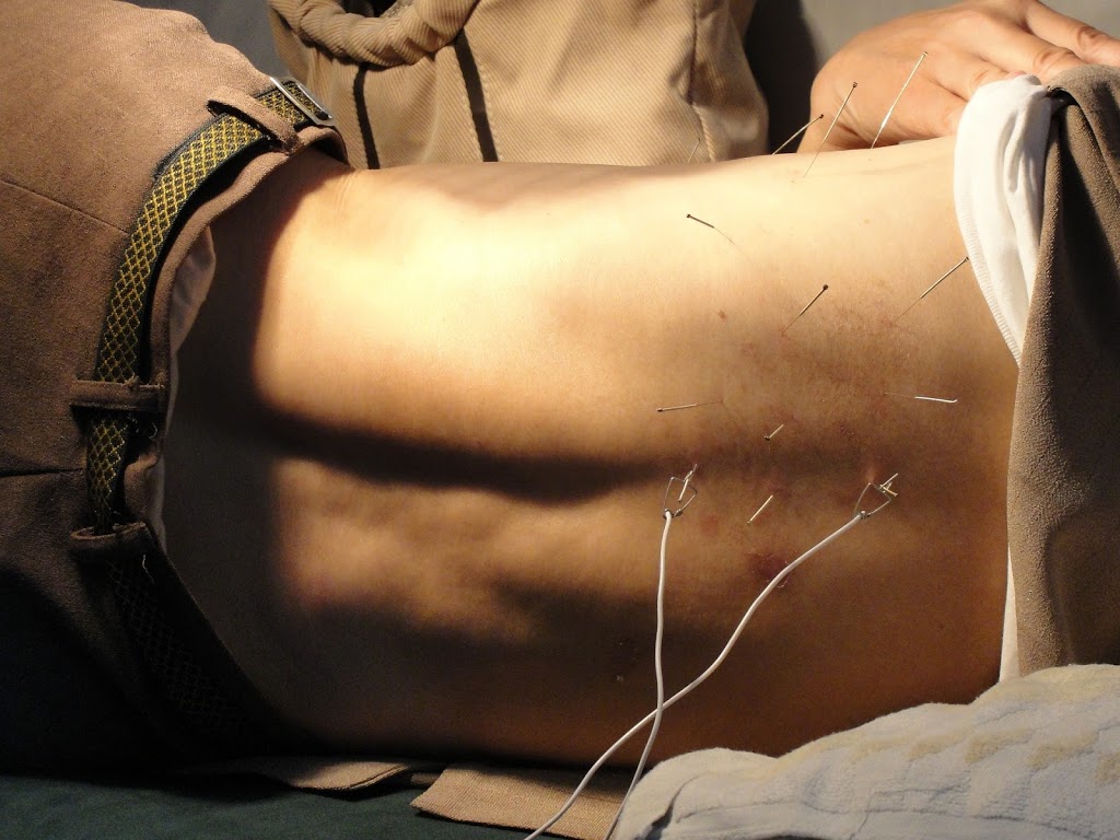 Acupuncture Marc Mauduit | 288 Boulevard DAnjou #317, Châteauguay, QC J6K 1C6, Canada | Phone: (450) 699-0000