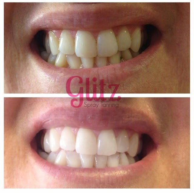 Glitz Spray Tanning | 1606 Sherwood Dr, Sherwood Park, AB T8A 1G5, Canada | Phone: (780) 691-8842