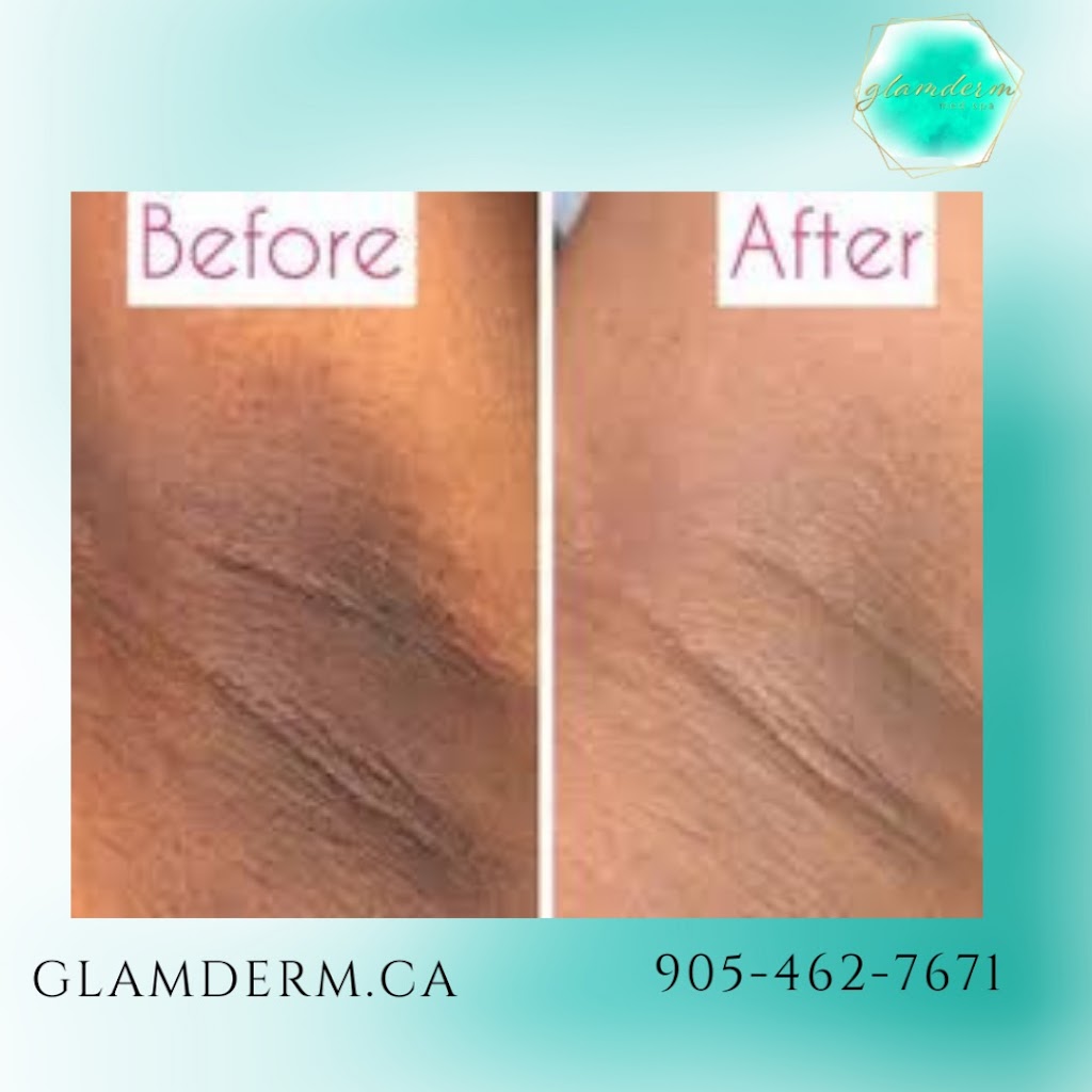 Glamderm Med Spa | 32 Village Centre Pl Suite 103 &104, Mississauga, ON L4Z 1V9, Canada | Phone: (905) 462-7671