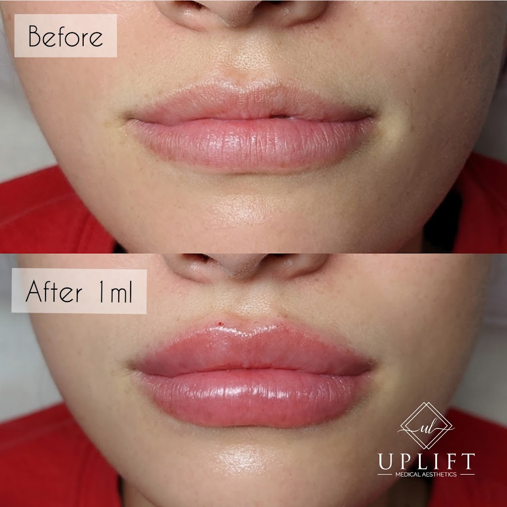 Uplift Medical Aesthetics | 2022 Main St N, Jarvis, ON N0A 1J0, Canada | Phone: (519) 420-9225