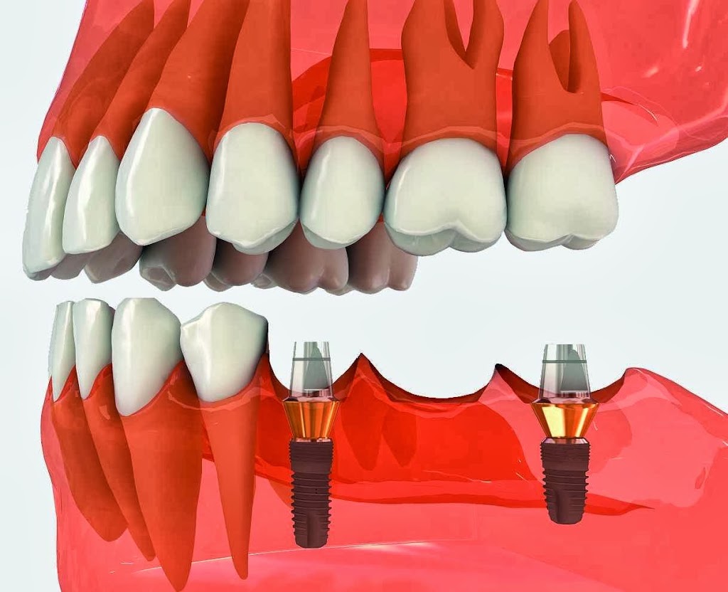 Champagne Dental Center | 7659a Rue Centrale, LaSalle, QC H8P 1L4, Canada | Phone: (514) 364-4658