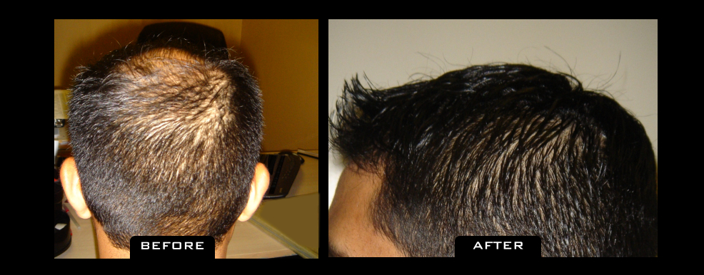 NuHair Medical | 6345 120 St #123, Delta, BC V4E 2A6, Canada | Phone: (604) 999-5747