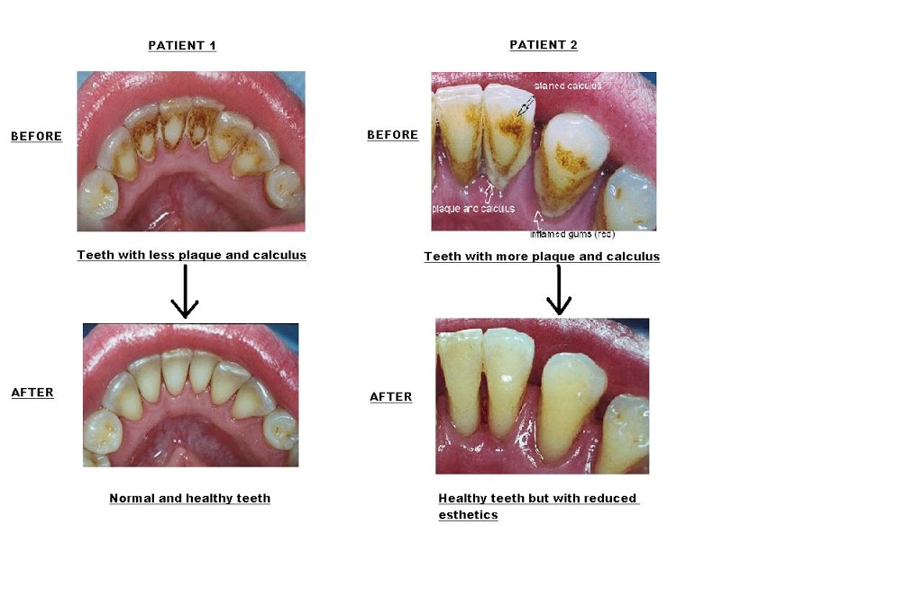 Surrey Dental Hygiene Clinic Inc | 12989 109 Ave, Surrey, BC V3T 2N2, Canada | Phone: (778) 395-0988