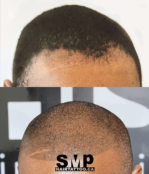 SMP® Scalp Micropigmentation Richmond Hill | HAIRTATTOO.CA | 9140 Leslie St #301, Richmond Hill, ON L4B 3L6, Canada | Phone: (647) 492-9093