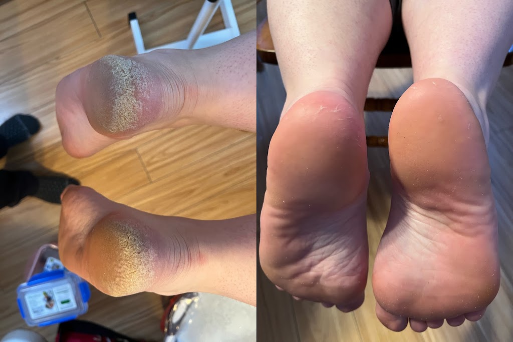 Highlands Foot Care | Young St, Maynooth, ON K0L 2S0, Canada | Phone: (519) 580-7121