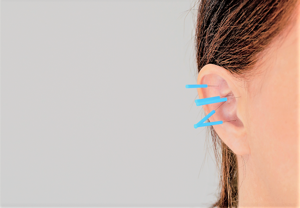 Balance To Heal Acupuncture | 304 Cranberry Park SE unit 202, Calgary, AB T3M 1W2, Canada | Phone: (705) 500-6601