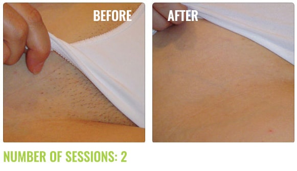 Mj’s laser & skin care studio | 8549 Fennell St, Mission, BC V4S 1M2, Canada | Phone: (778) 885-8400