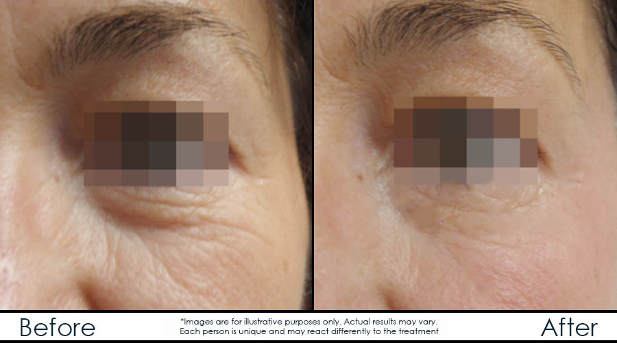Infinium Médecine Esthétique | 729 Boulevard Saint-Joseph, Gatineau, QC J8Y 4B6, Canada | Phone: (819) 771-4284