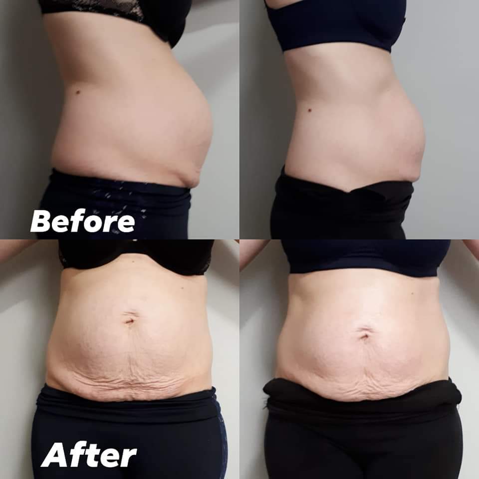 Valencia Body Contouring Inc. | 147 Bridlecrest St SW, Calgary, AB T2Y 5J1, Canada | Phone: (403) 473-4622