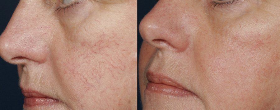 Skin Care Lazer YXE | Sunsera Salon. Ask for Olga (Laser technician, 815 Gray Ave, Saskatoon, SK S7N 2K6, Canada | Phone: (639) 318-9969