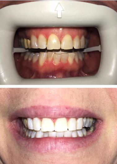 Keswick Dental Centre | 417 The Queensway S #202, Keswick, ON L4P 2C7, Canada | Phone: (905) 476-4371