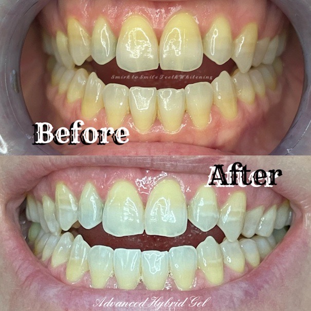 Smirk to Smile Teeth Whitening | 10 Jensen Crescent NE, Airdrie, AB T4B 1P4, Canada | Phone: (403) 404-1421