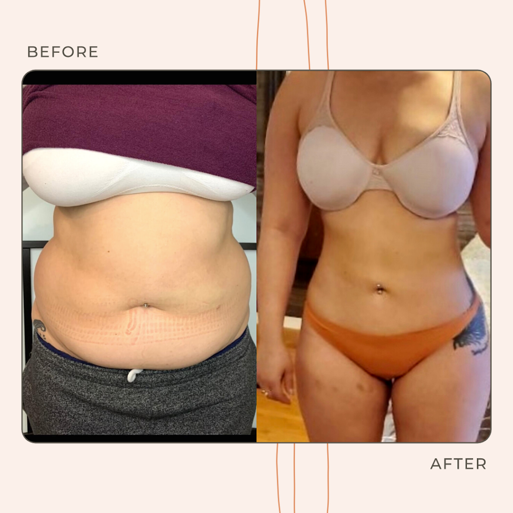 Snatched by Ale Fat Freezing | 59 Cathedral High St Unit 1, Markham, ON L6C 0P1, Canada | Phone: (647) 806-5353