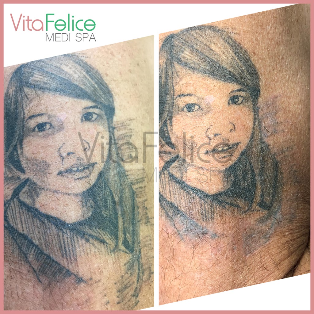 Vita Felice Medi Spa | 661 Columbia St, Unit 103, New Westminster, BC V3M 1A8, Canada | Phone: (778) 987-5480