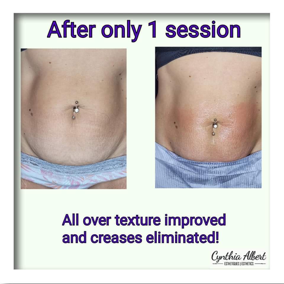 Esthétiques Cynthia Albert | 32 Rue Robillard, Notre-Dame-de-lÎle-Perrot, QC J7V 6S7, Canada | Phone: (514) 992-0827