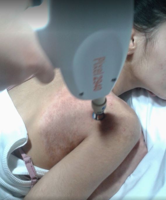 Laser Body Care | 10056 140 St, Surrey, BC V3T 4M7, Canada | Phone: (778) 898-7881