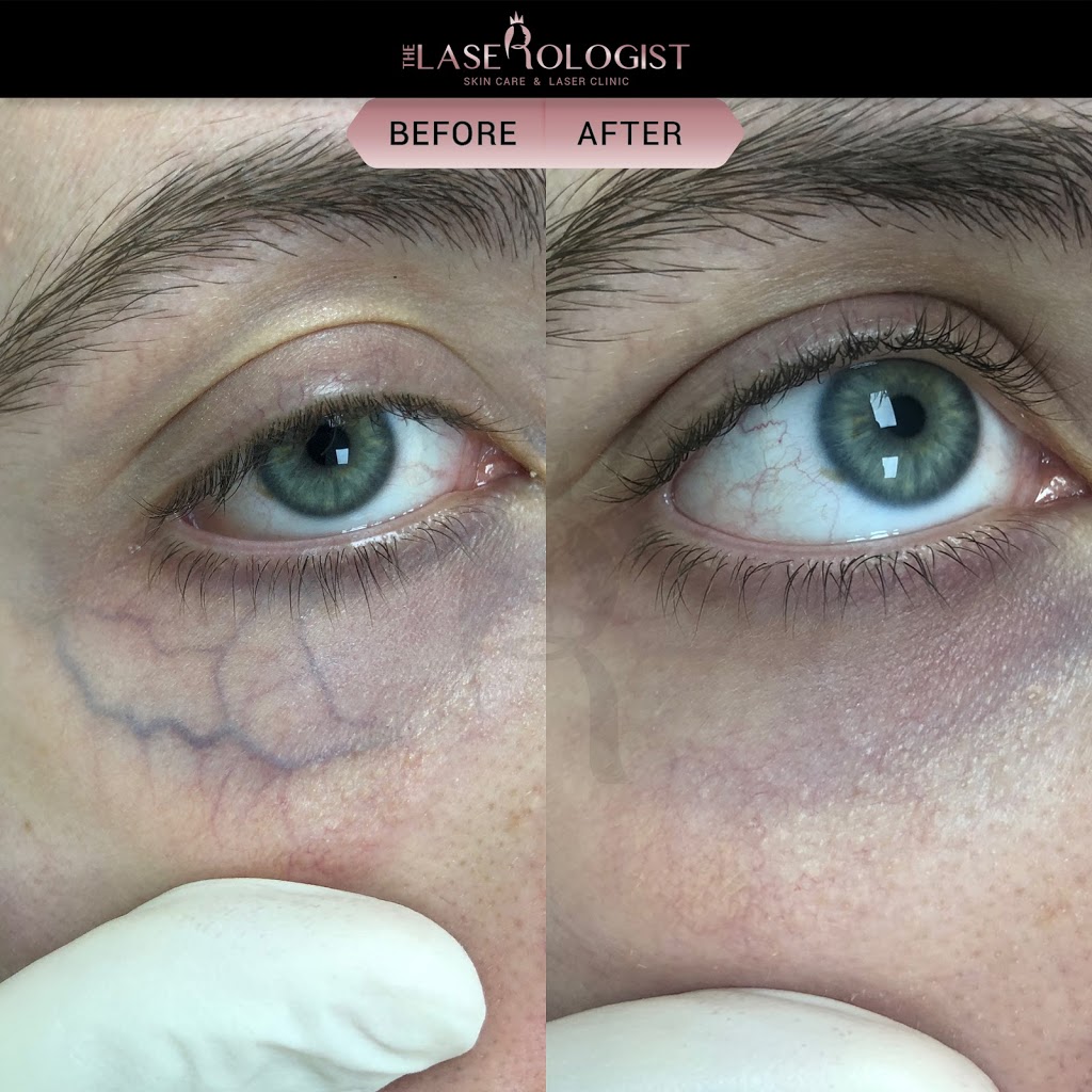 The Laserologist | 69 Bethune Ave, Hannon, ON L0R 1P0, Canada | Phone: (905) 519-7232