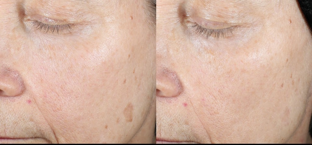 Carewell Laser Esthetics | 6490 Old Banff Coach Rd SW, Calgary, AB T3H 5R8, Canada | Phone: (604) 312-3034