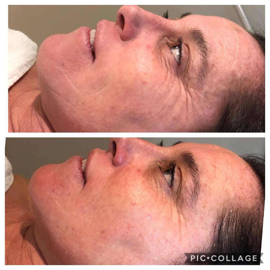 Bianka Nadon laser et rajeunissement | 1001 Rue Émile-Bouchard, Vaudreuil-Dorion, QC J7V 0W3, Canada | Phone: (514) 912-6490