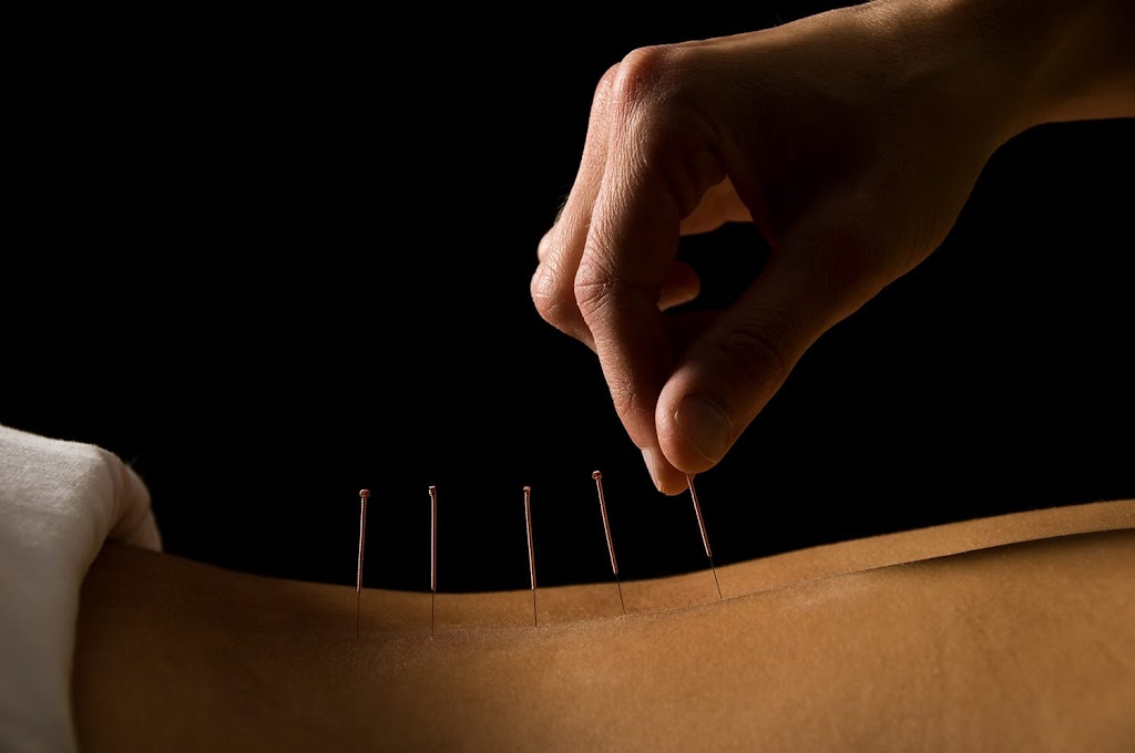 Island Registered Massage Therapy & Acupuncture | 3353 First St, Cumberland, BC V0R 1S0, Canada | Phone: (250) 588-5659