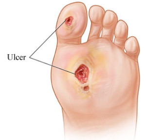 Tsawwassen Podiatrist Dr. Dixon | 218- BC V4L 2A2, 1077 56 St, Delta, BC V4L 2A2, Canada | Phone: (604) 943-4405