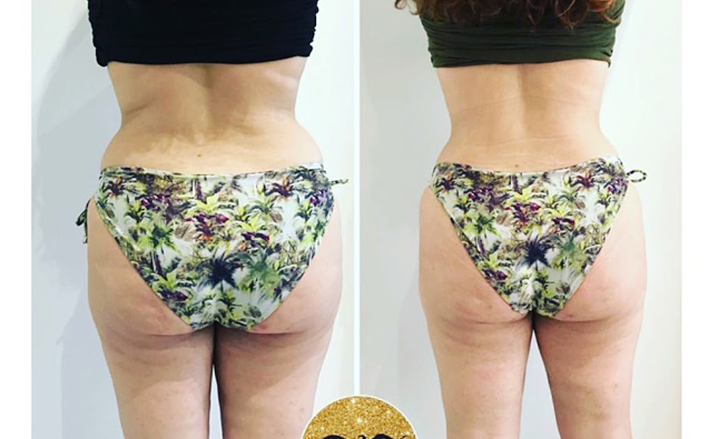 Esthétique Euro laser - Soin du visage Saint Laurent | 3500 Boulevard Cote Vertu Ouest Suite 130, Saint-Laurent, QC H4R 1P8, Canada | Phone: (514) 823-5292